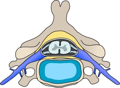 Protebius selgroolülides koos emakakaela osteokondroosiga